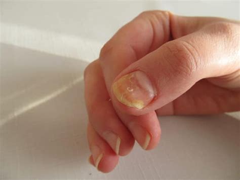 how to get rid of yellow nails 1