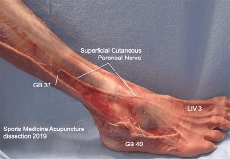 Peroneal Nerve Entrapment: A Common Lower Leg Pain Generator