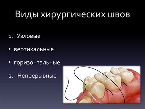 Швы, используемые в хирургической стоматологии. Техника наложения ...