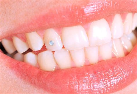 Стразы на зубах | DENTAL-INFO