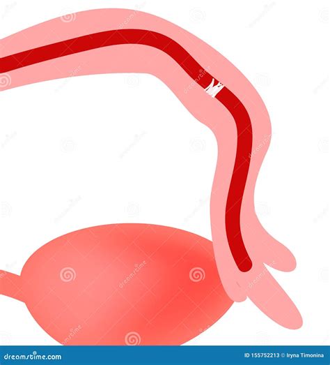 Diagram Of Uterus And Fallopian Tubes