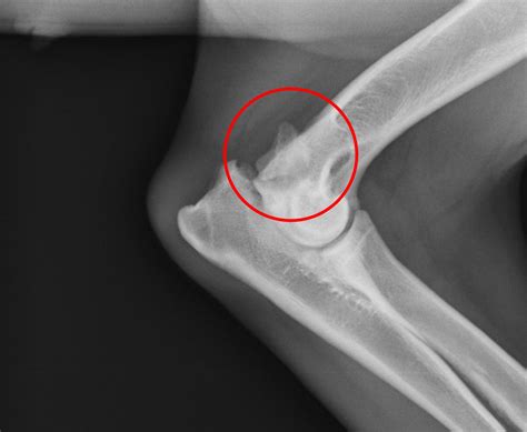elbow fractures fractures fracture dislocation disloc vrogueco