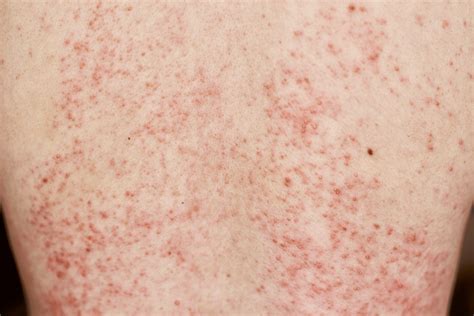Rashes - Cathedral Dermatology