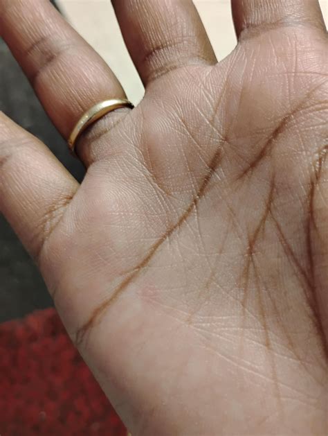 Two tiny pimple-like bumps on hands, what could they be? : r ...