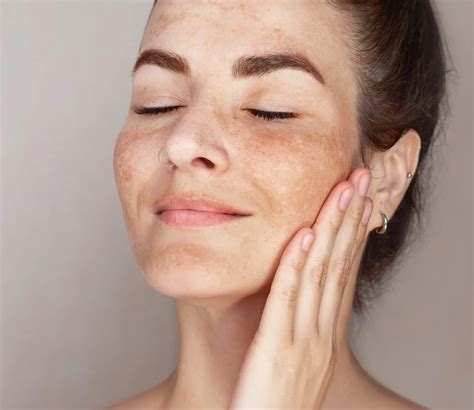 Melasma Treatment in Celina, TX | Everoak Dermatology