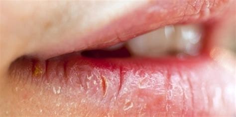 Labios Ressecados E Rachados