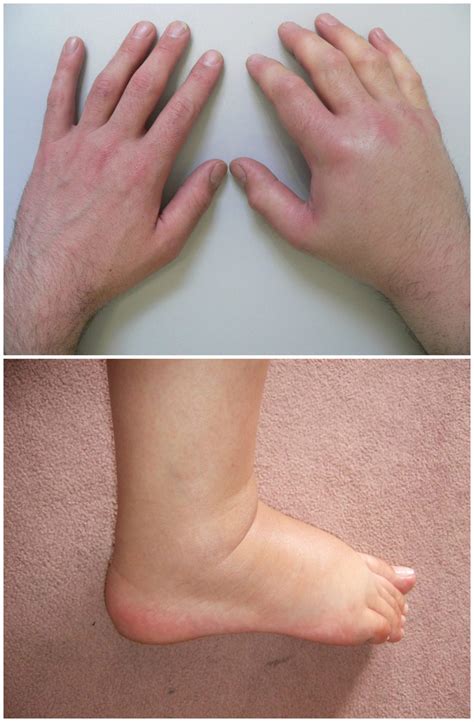 If Your Body Is Swelling It Might Be a Sign of an Advanced Illness