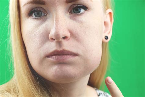 facecheek swelling malvern east toorak victorian dental group