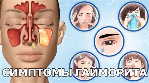 Симптомы гайморита - YouTube