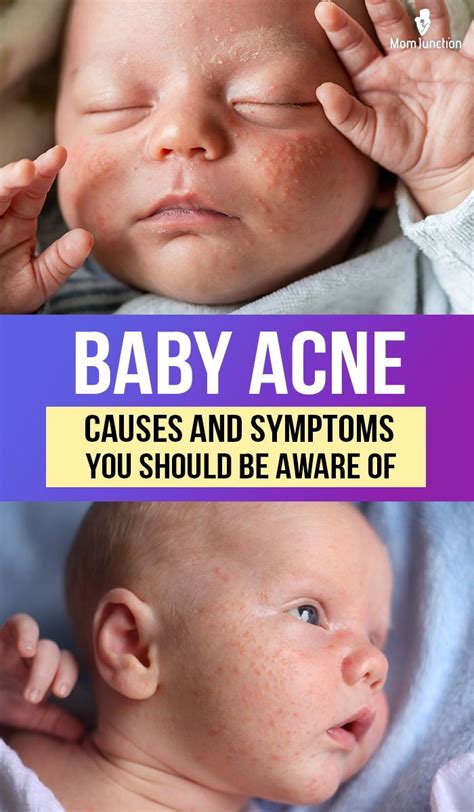 how to get rid of newborn acne