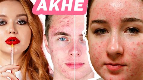 АКНЕ изучение проблемы! (Лекция 5-6 из марафона по лечению АКНЕ) - YouTube