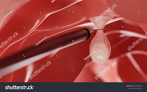 Colon Polyp Removal Endoscope Inside Colonoscopy Stock Illustration ...