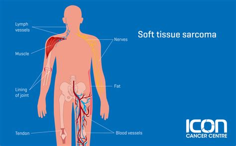 What is Soft Tissue Sarcoma? Soft Tissue Sarcoma Explained — Icon ...