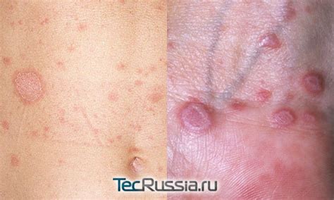 Сухі плями на шкірі. що це, фото у дорослого, дитини. червоні, білі ...