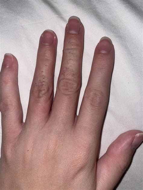 Small red bumps on fingers : r/medical