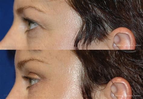 temple lift skin tightening manhattan upper east side