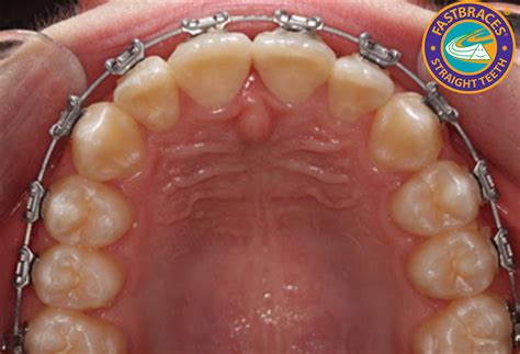 fastbraces provider orillia dentist