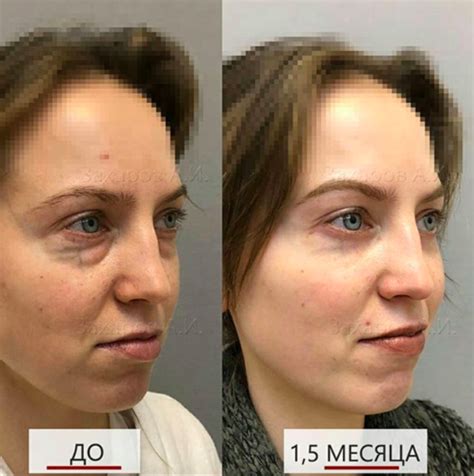 Эндоскопический лифтинг лица - Медицинский центр «ЗДОРОВЬЕ»