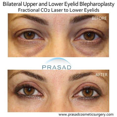 pixel laser eye treatment  dark circles
