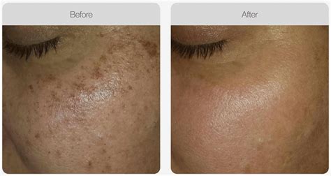 IPL Laser Phototherapy for Pigmentation • NASCENT Skin and Beauty Clinic