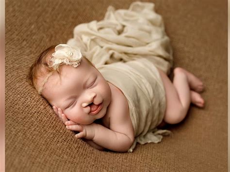 How Are Es Born With Cleft Lip And Palate - Infoupdate.org