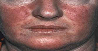Policitemia Vera Rosto - Plethoric Face Polycythemia Vera EM@3AM: Polycythemia EmDocs