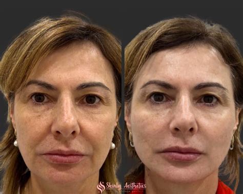 PDO Thread Lifting - Before and After Results at Skinly Aesthetics