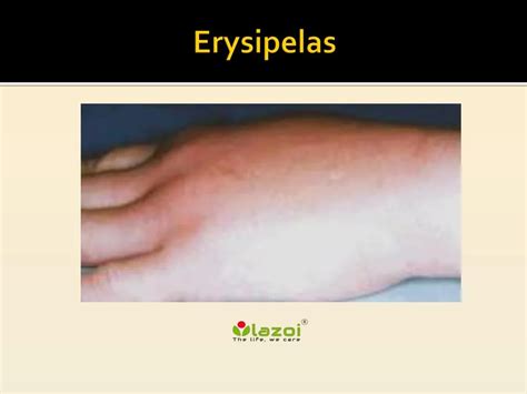 PPT - Erysipelas: Symptoms, Causes, Diagnosis and Treatment PowerPoint ...