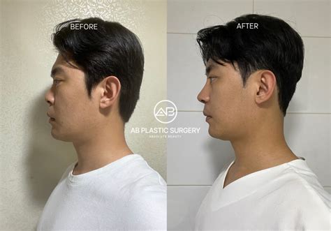 fix  flat nose    surgery ab plastic surgery korea