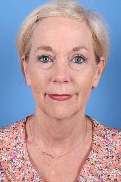 Phenol Peel Before & After Patient 6962 | Dr. Sukkar