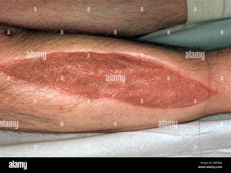 compartment release fasciotomy  barbara mcdonnell blog