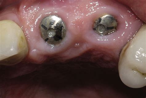 healing abutment implant