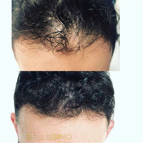 PRP Hair Loss Treatment - Bellissimo Clinic