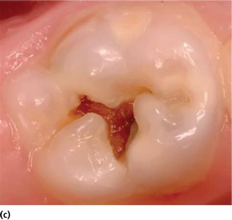 Caries Ativas E Inativas - Caries Ativas E Inativas - RETOEDU
