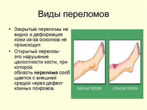 Переломы Выполнили Ученицы 8 класса Лицея им Н