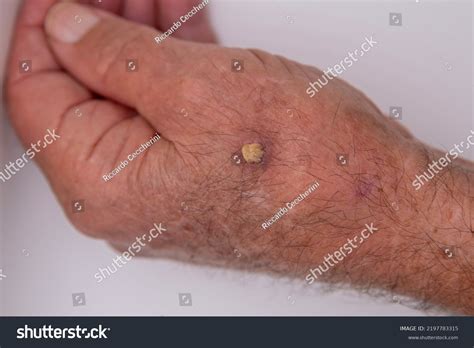 4件の「Cutaneous horn」の画像、写真素材、ベクター画像 | Shutterstock