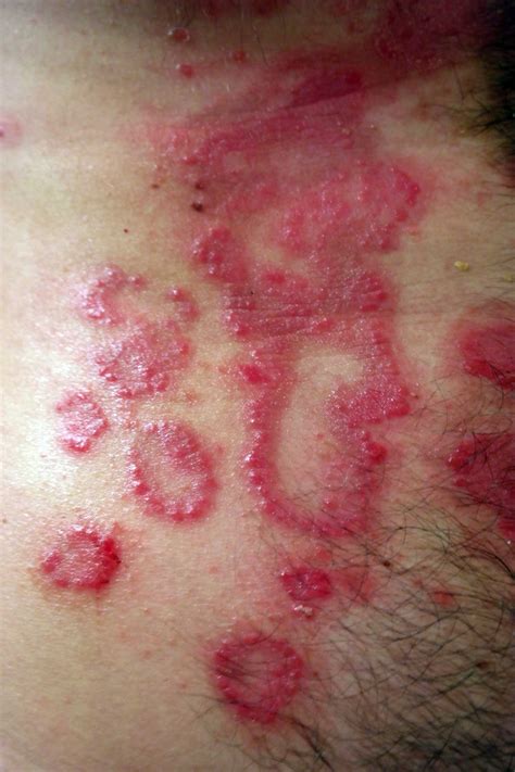 Psoriasis What is it? - Pictures, Causes, Symptoms, Treatment
