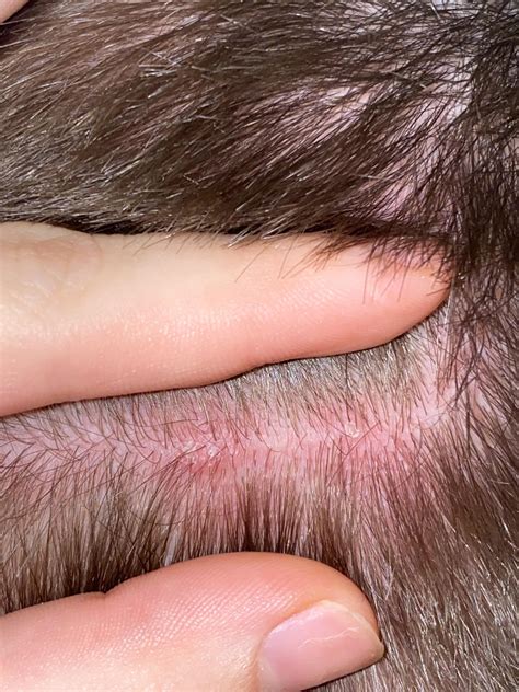 Can dandruff cause this? : r/dandruff