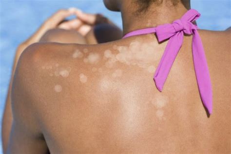 how to get rid of white spots from tanning