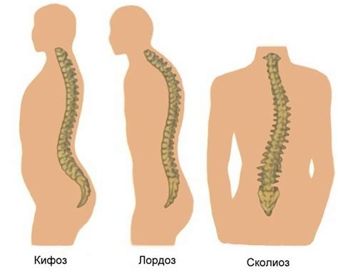 Виды искривления позвоночника, лечение лордоза, кифоза и сколиоза