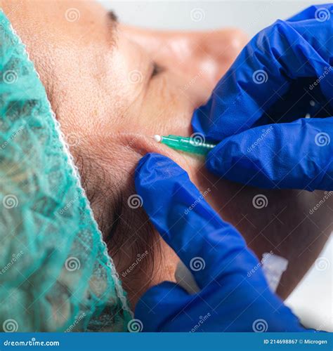 meso threads face lifting treatment mesotherapy  aesthetic medicine