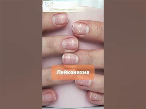 Как печень подаёт сигналы через кожу, ногти и волосы - YouTube