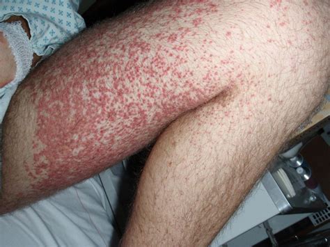 Henoch-Schönlein purpura: Causes, symptoms, and treatment