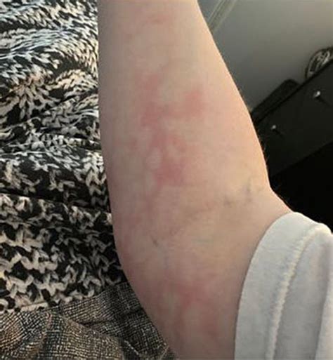 Post Viral Rash