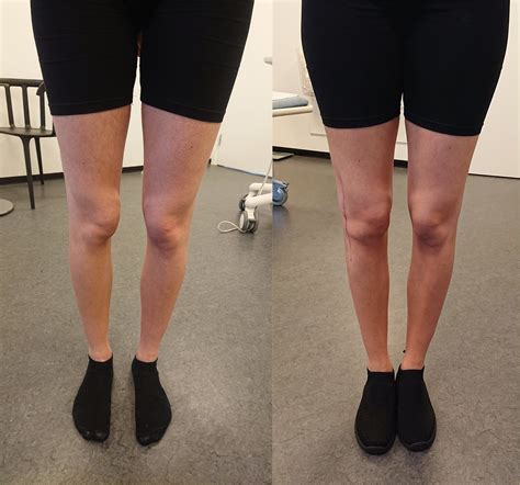 Anterior Knee Pain If you have chronic AKP, surgery may be considered