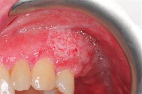 How to Check Yourself For Mouth Cancer - Coatbridge Family Dental Care