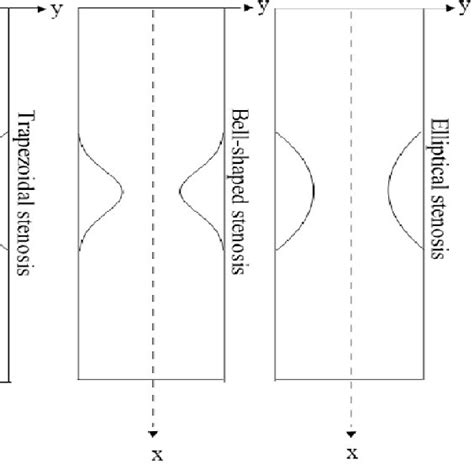 schematic diagrams   artery   types  stenosis