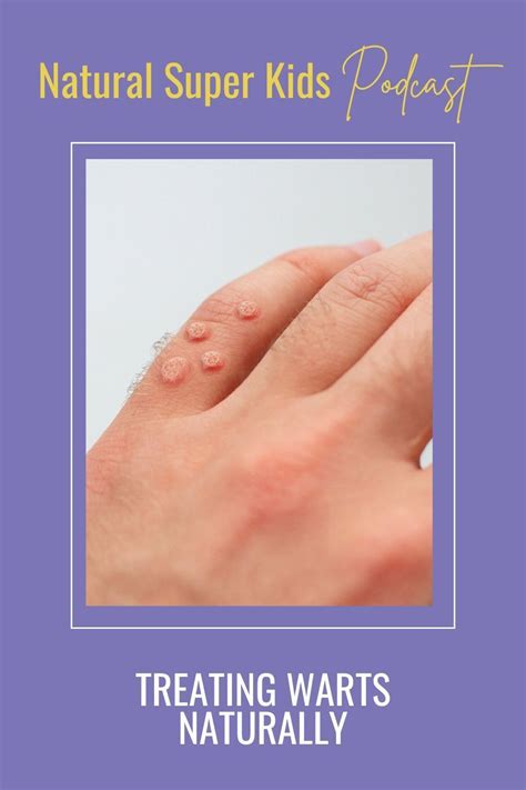 Best 12 The Easiest Way to Get Rid of Warts Naturally – Artofit