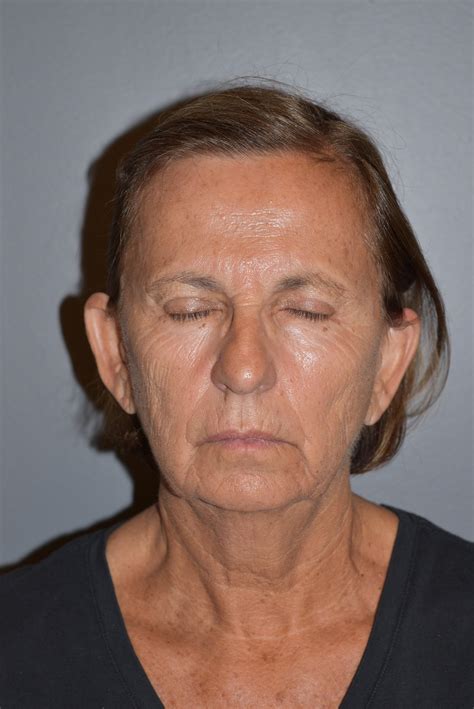 Mini Face Lift Gallery — North Shore Plastic Surgery