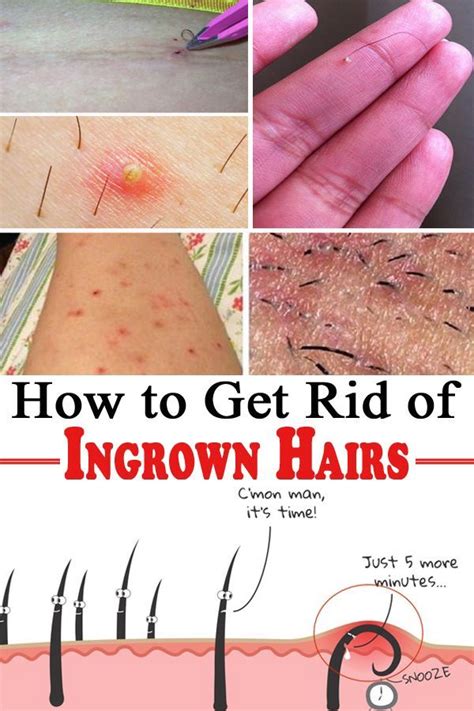 how to treat ingrown hair bump